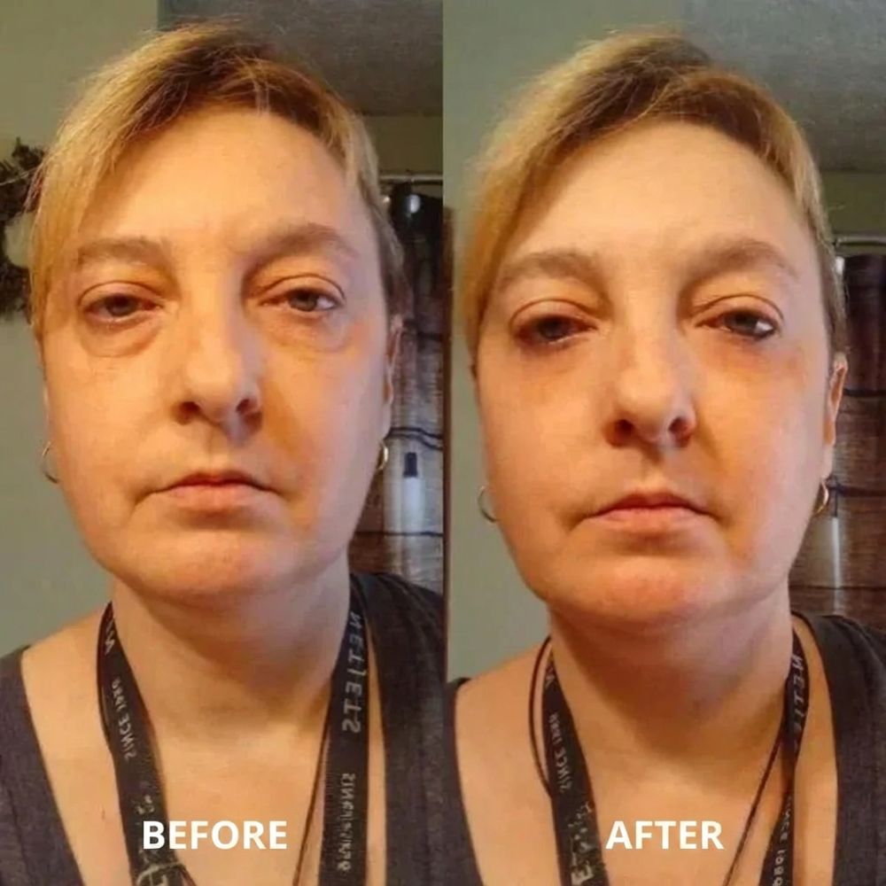 Peptide collagen hydrogel EyePatch