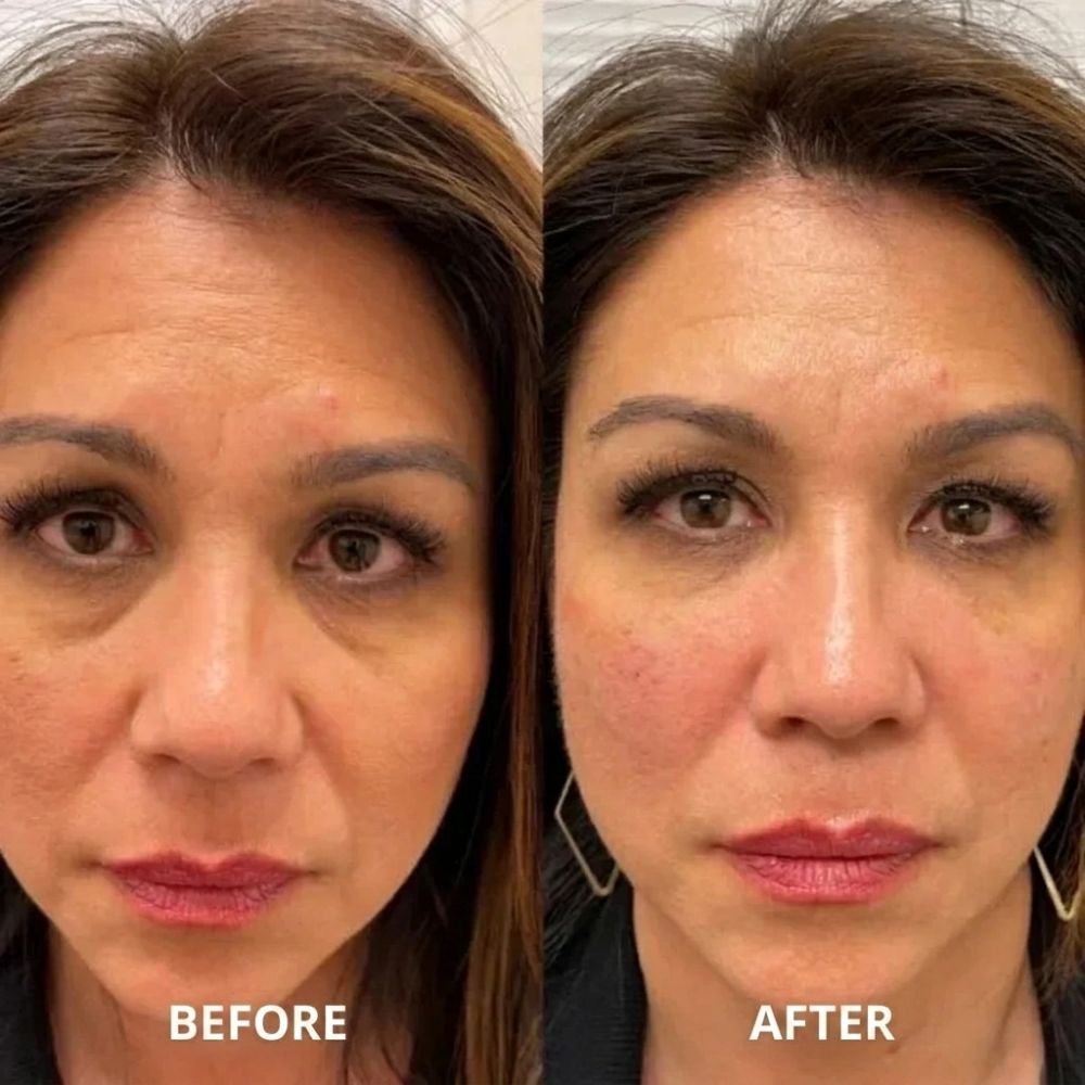 Peptide collagen hydrogel EyePatch