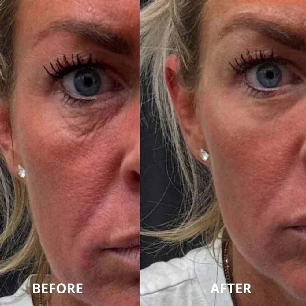 Peptide collagen hydrogel EyePatch